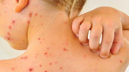 Baca juga : Dikes Catat Kasus Campak di Kota Malang Turun: Dari 27 Pasien Kini Tersisa 1 Pasien