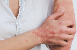 Cacar Monyet Masuk Indonesia, Dinkes Kota Surabaya Lakukan Sejumlah Upaya Pencegahan