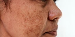 Dokter: Penyebab Munculnya Flek Hitam pada Wajah