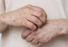 Cacar Monyet Berstatus Darurat, Profesor Zubairi  Bagi Cara Cegah Penularan