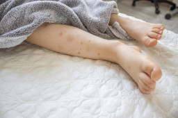 Tanda Kutu Busuk Sudah Menyebar di Rumah