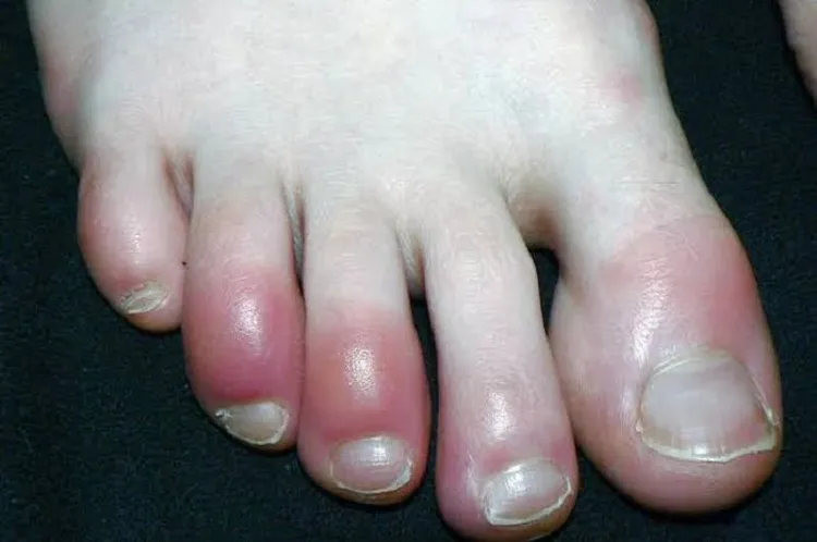 Tips Menangani Gejala Ruam Jari Kaki Covid Toes