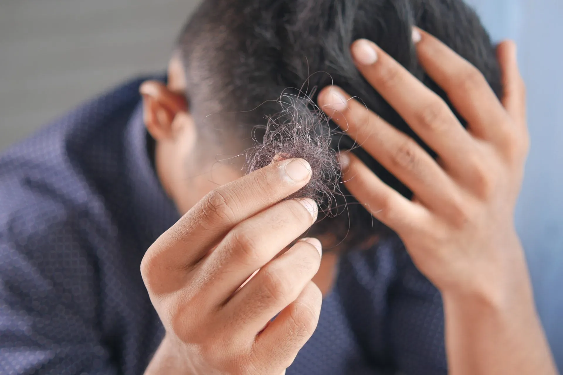 Studi: Stres Bisa Sebabkan Kerontokan Rambut