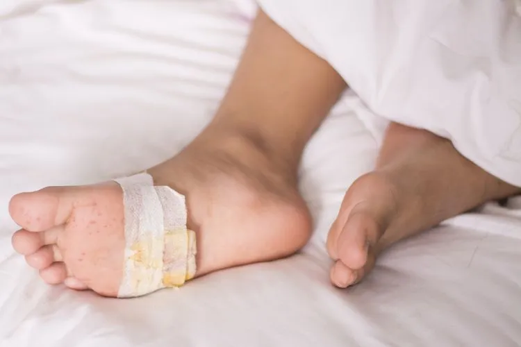Cara Cegah Luka Kaki Diabetes Agar tak Memburuk