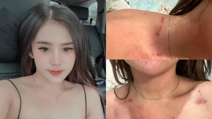 Cemburu, Selebgram Cantik Sidoarjo Dianiaya Pacarnya Hingga Babak Belur