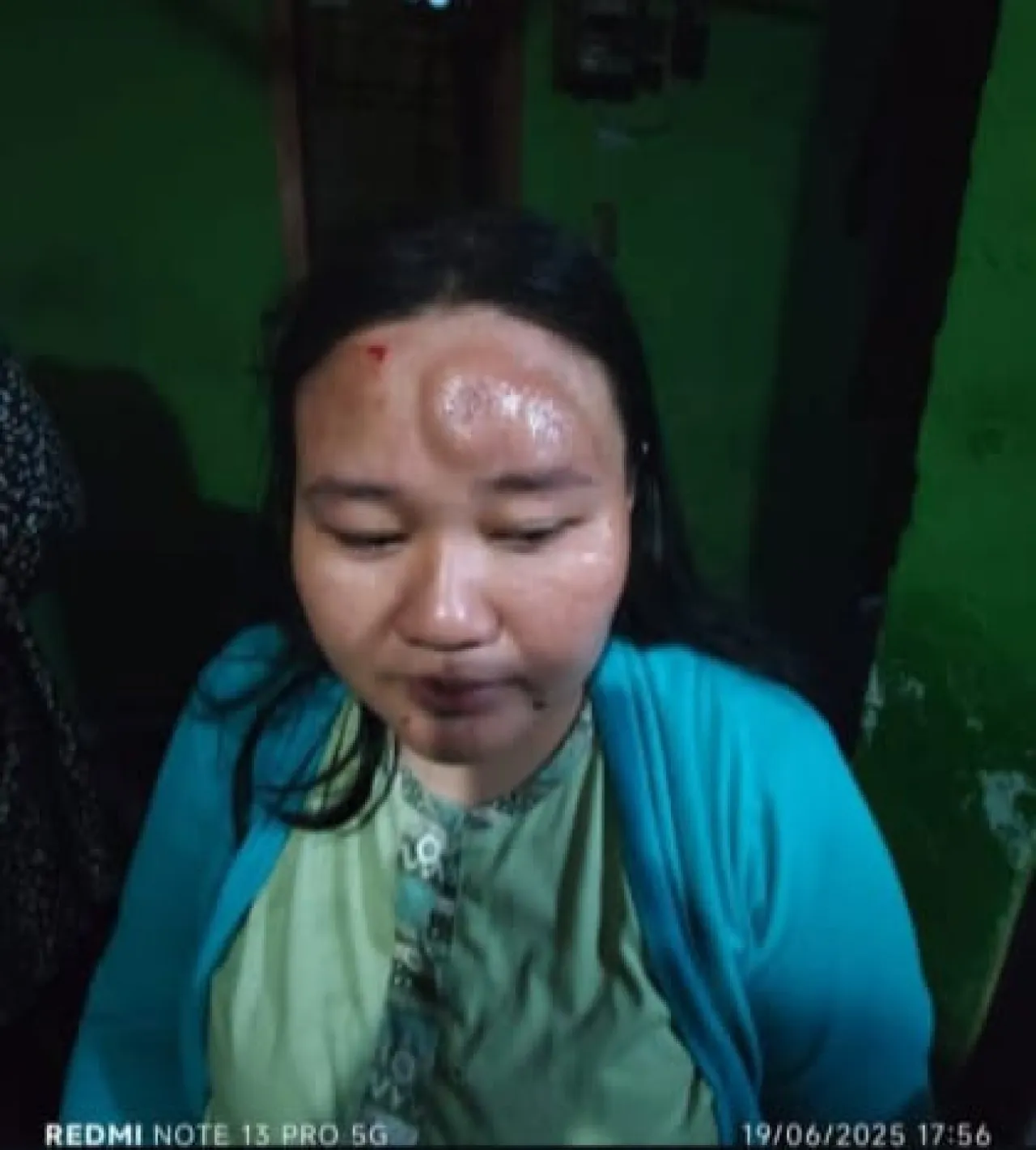 Viral di Medsos, Ibu Muda Rungkut Surabaya Jadi Korban KDRT Usai Cekcok Soal Uang