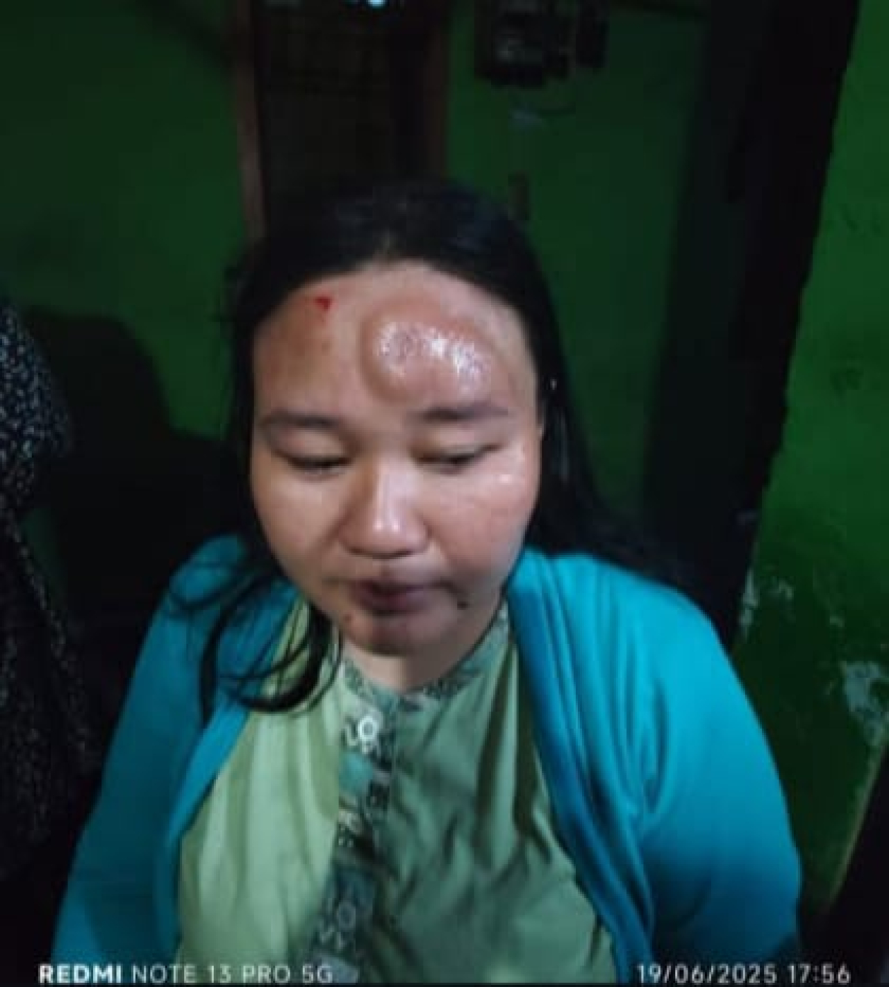 Kondisi Shella saat jidatnya masih terlihat memar.