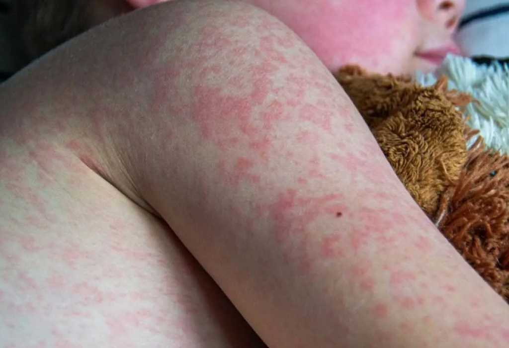 Peristiwa Dinkes Catat Ratusan Anak di Surabaya Terdata Suspek Kasus Campak, Mayoritas Anak-anak