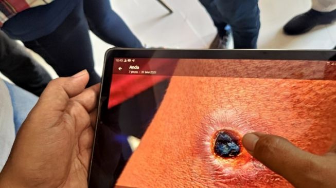 Petugas menunjukkan foto infeksi kulit pada lengan warga pascakematian 26 ekor sapi akibat bakteri antraks di Desa Sidomulyo, Kecamatan Pagerwojo, Tulungagung, Jawa Timur, Senin (7/6/2021). SP/ANT/Destyan Sujarwoko