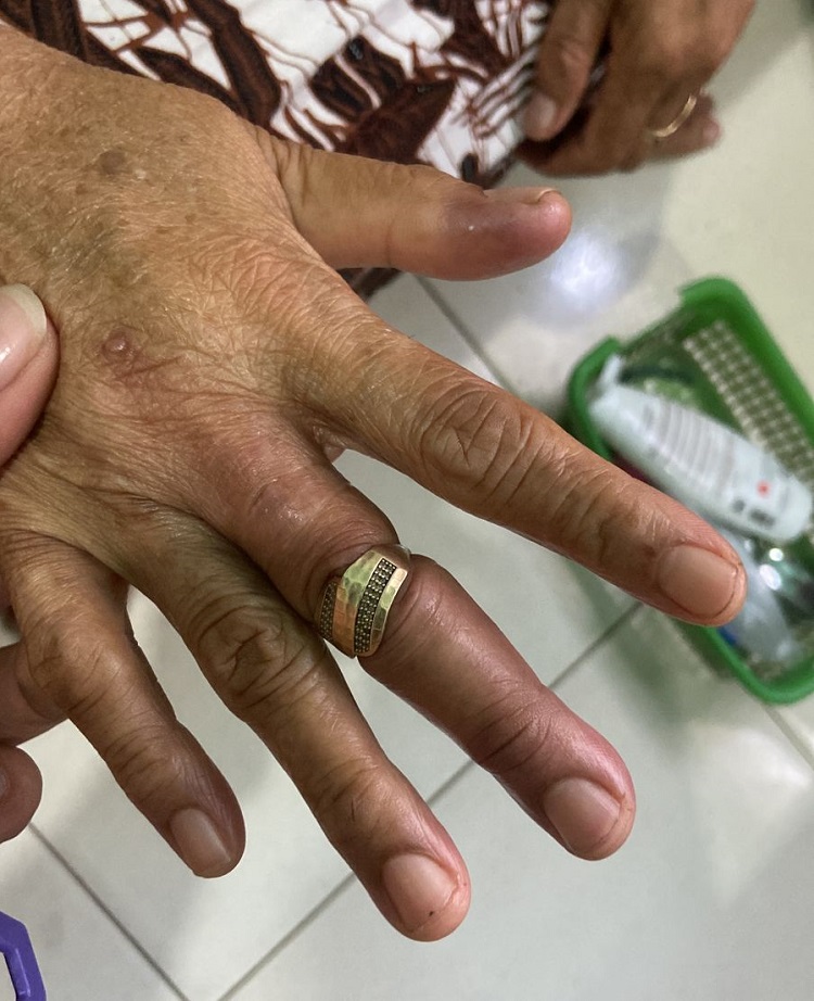 Tim Damkar Sidoarjo saat membantu melepaskan cincin yang melekat pada nenek (64) warga Pilang, Kecamatan Wonoayu. SP/ Hikmah