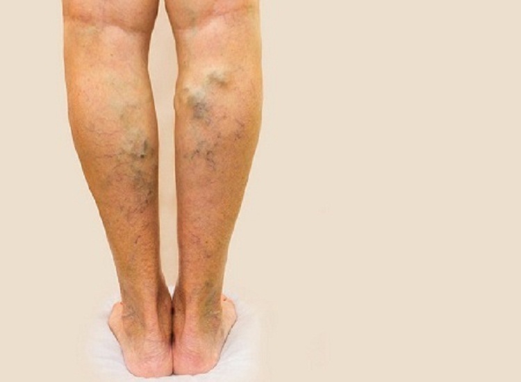 Salah satu kondisi varises yang parah. SP/ SBY